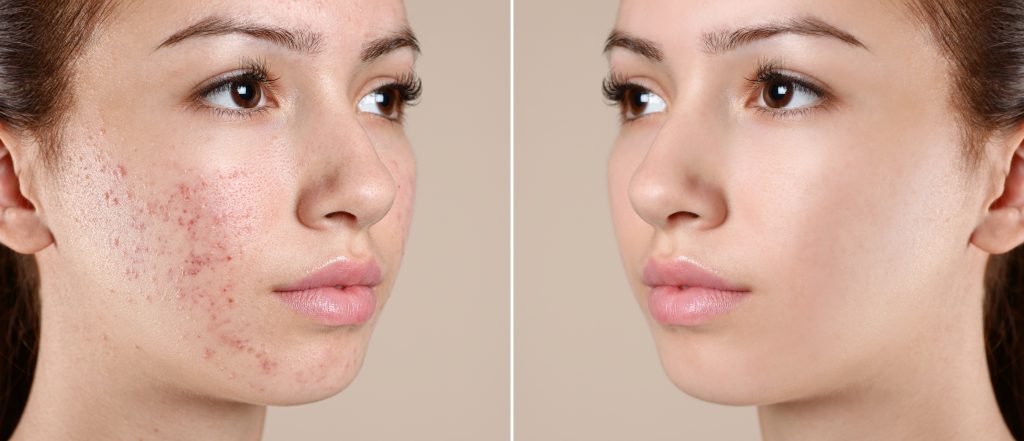 Geheim Geldschieter jaloezie Acne - Skin Improvement & Beauty