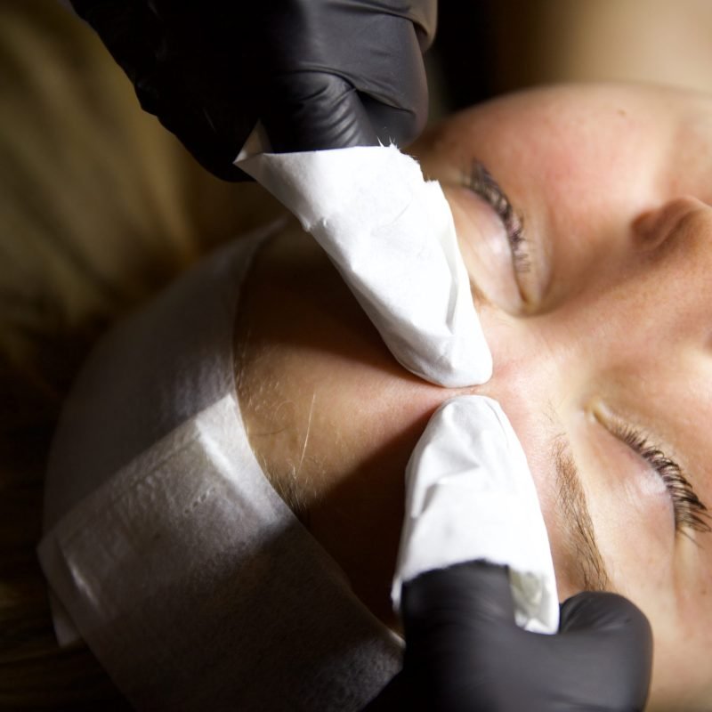 temp-sib acne behandeling amsterdam