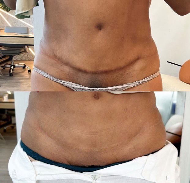 camouflage striae amsterdam