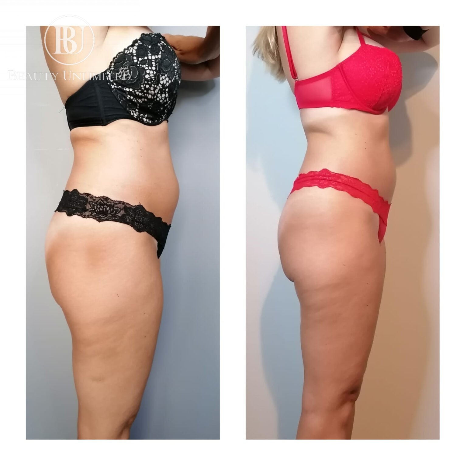 cryolipolyse amsterdam