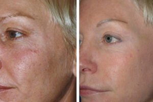 sib erbium laser behandeling