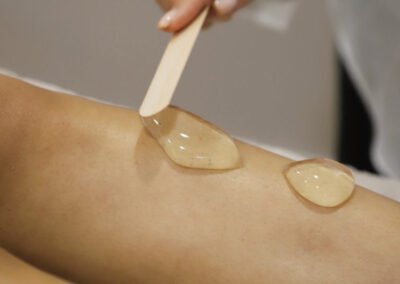 sib laser ontharen behandeling