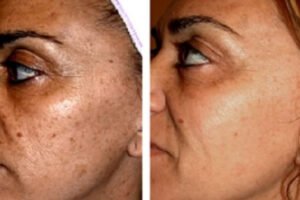 sib pigmentatie laserbehandeling