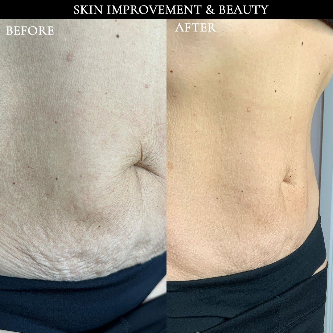 sib voor na striae inkless stretch mark therapy