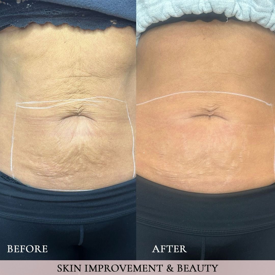 voor na striae behandeling