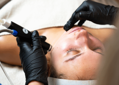 microneedling-skin-improvement-beauty