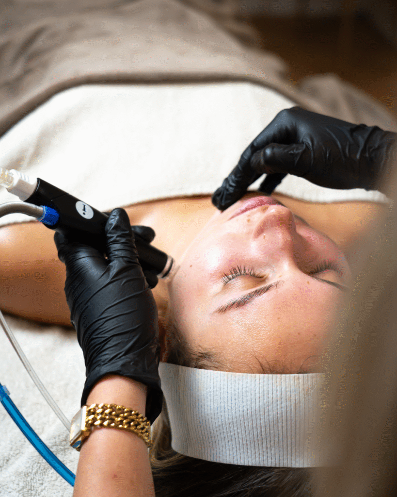 microneedling-skin-improvement-beauty