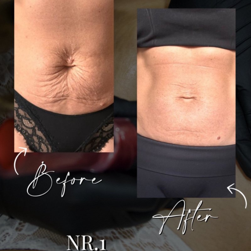 temp-sib voor na inkless stretch mark professionals