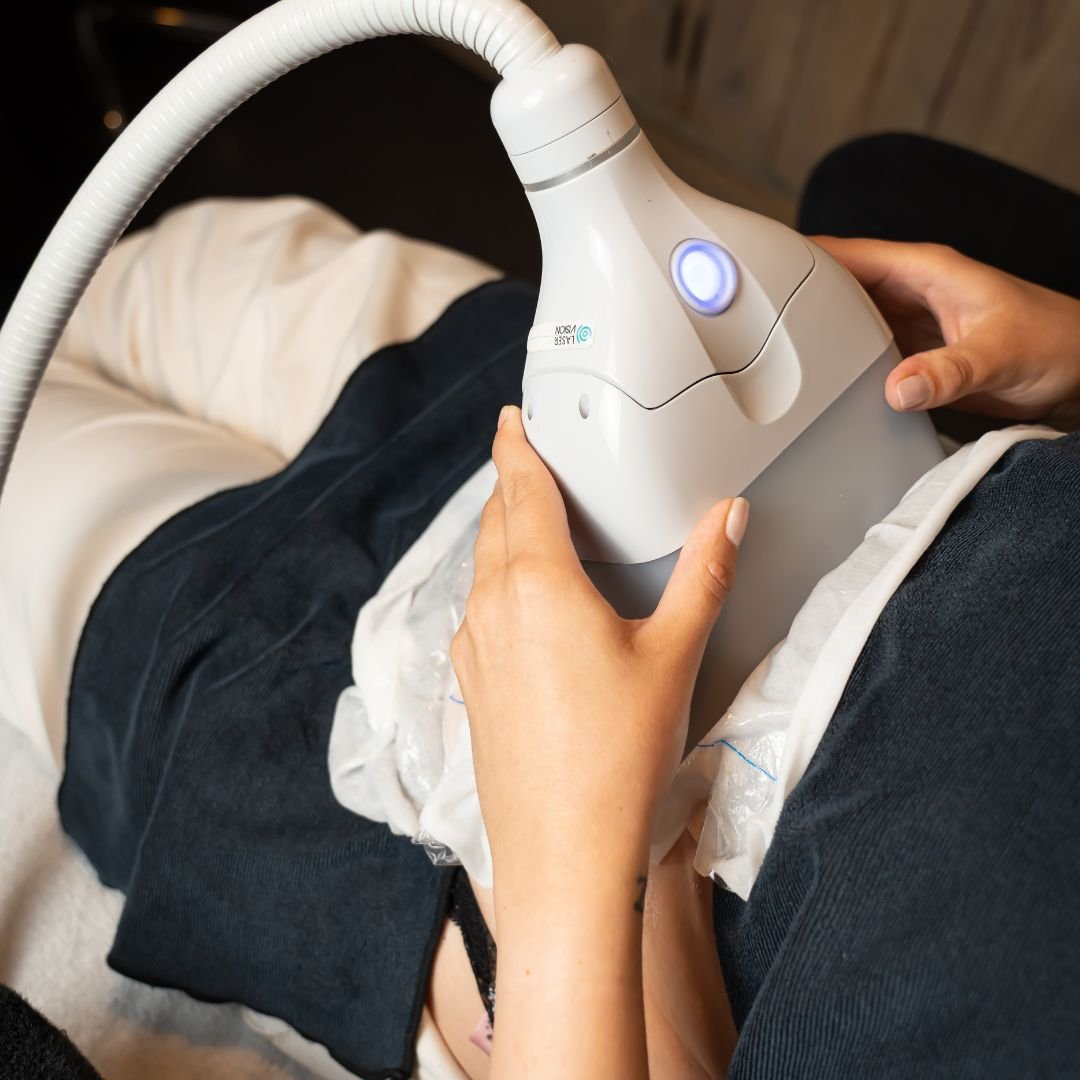 cyro-lipolyse-skinimprovement-beauty-amsterdam