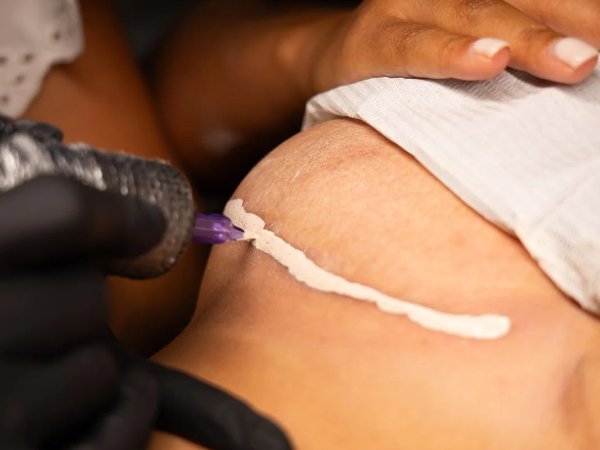 gratis_huidscan_4_3 scar lightening & camouflage techniek